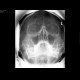 Polyp of the right maxillary sinus: X-ray - Plain radiograph
